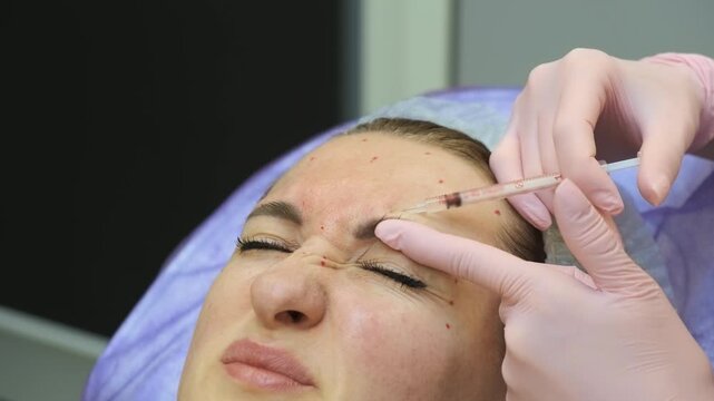 Close up cosmetic injections on female face during dermatology treatment session. Practitioner working on forehead lines and crow feet area with careful precision. Biorevitalization method improving