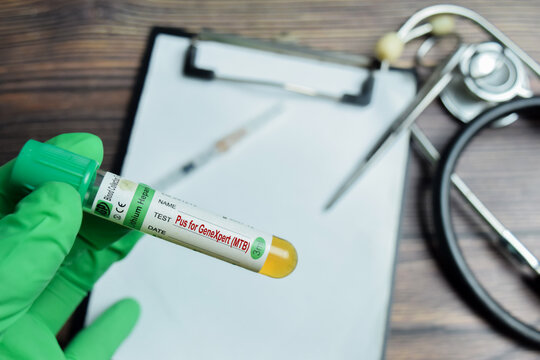 pus sample for GeneXpert - MTB Test with blood sample in green gloved hands. To detect Mycobacterium tuberculosis DNA and rifampicin resistance