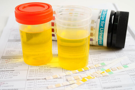 Urinalysis, urine cup for check health examination in laboratory.