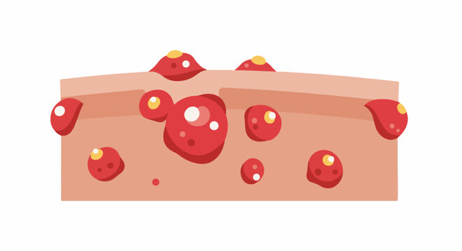Stylized illustration of inflamed skin with multiple red pustules and blemishes