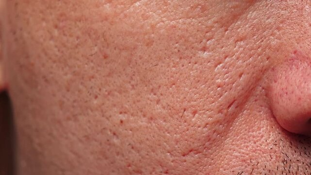 Post-acne man with scars on face texture close up