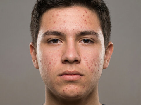 Teenage boy with moderate acne vulgaris showing papules pustules and blackheads on face, adolescent skin problem dermatology concept