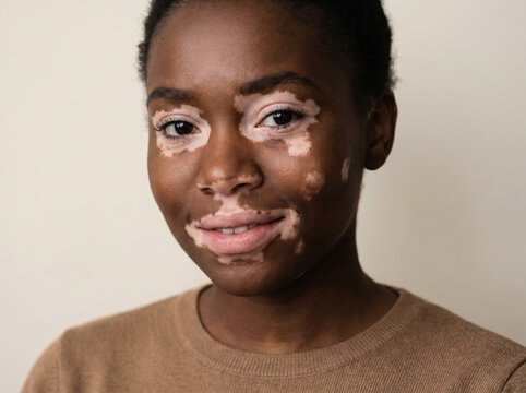 Portrait of black woman with vitiligo showing white depigmented patches on face around eyes and lips, skin pigmentation disorder awareness concept