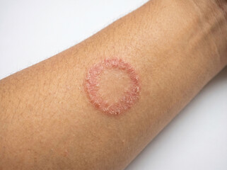 Fototapeta premium Close-up of ringworm tinea corporis on arm showing circular red scaly fungal lesion ring shaped rash, dermatology skin infection concept