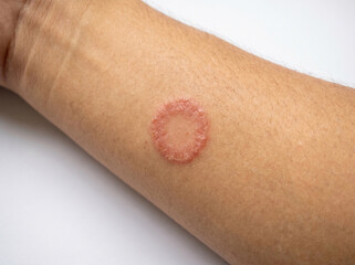 Fototapeta premium Close-up of ringworm tinea corporis on arm showing circular red scaly fungal lesion ring shaped rash, dermatology skin infection concept