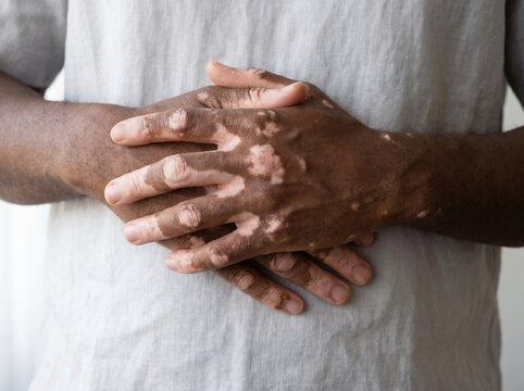 Close-up of dark skin hands with vitiligo showing depigmented white patches on fingers and wrists, autoimmune pigmentation skin condition concept
