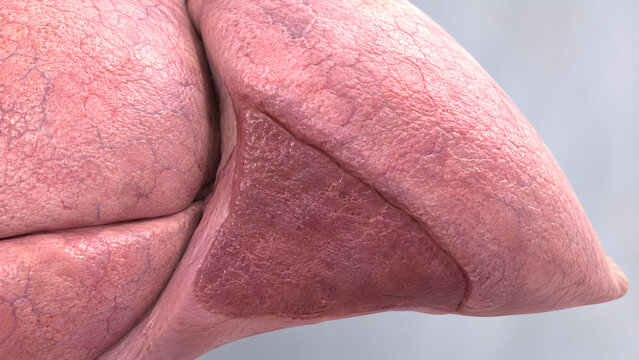 Wedge-Shaped Lung Collapse with Volume Loss, Photorealistic 3D Medical Render for Radiology and Patient Education