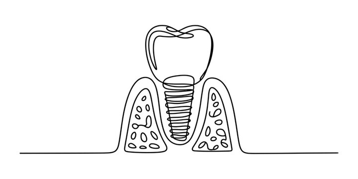 Continuous single line drawing of a dental implant tooth in the gum showing the metal screw post for professional medical and clinic dental care Vector, illustration