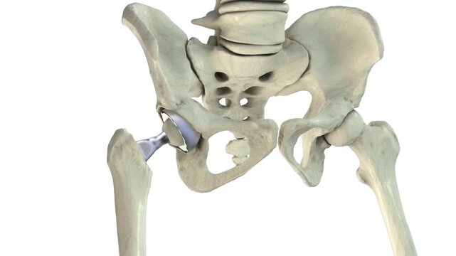 Total hip replacement implant positioned within femur and acetabulum, camera slowly rotating around prosthesis on white background, detailed orthopaedic 3D animation.