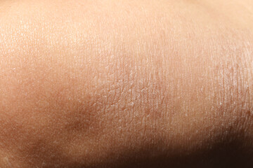Fototapeta premium Texture of dry skin as background, closeup