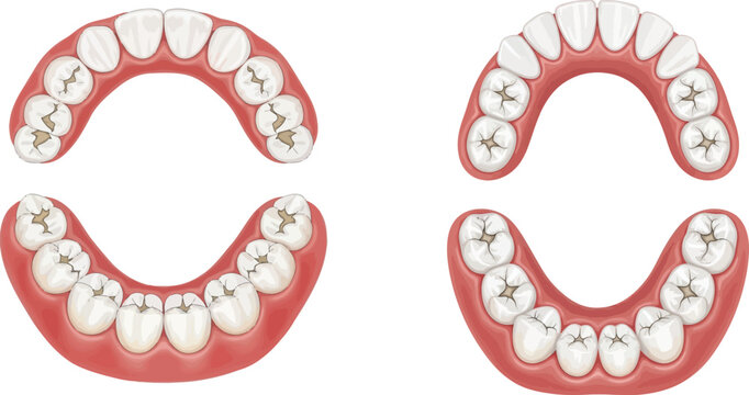 An illustration of upper and lower teeth with several cavities on a white background