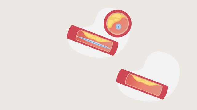 Coronary Artery Disease - Plaque Buildup in Heart Arteries - Ballon Angioplasty - Stock Animated Illustration as MP4 File
