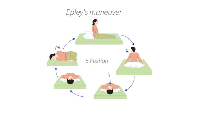 Epley Maneuver for Benign Paroxysmal Positional Vertigo (BPPV)
Epley maneuver used to treat benign paroxysmal positional vertigo (BPPV) and reposition inner ear crystals.