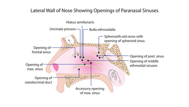 Lateral Wall of Nose Showing Openings of Paranasal Sinuses
lateral nasal wall with turbinates removed showing drainage openings of paranasal sinuses.