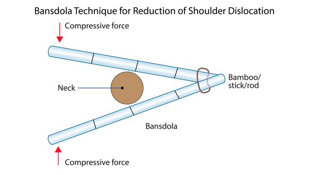 Bansdola Technique for Reduction of Shoulder Dislocation
Orthopedic illustration demonstrating the Bansdola method using compressive force and a rod for shoulder dislocation reduction.