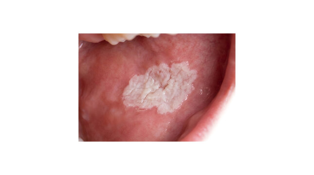 Oral Leukoplakia patch inside human mouth showing precancerous lesion
