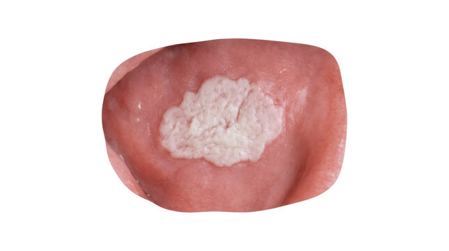 Leukoplakia oral patch on human tongue closeup