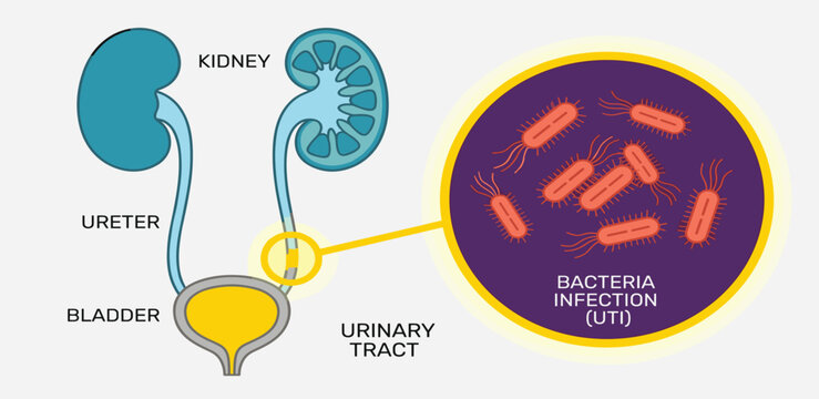 An illustrated diagram showing the human urinary tract and a magnified view of bacteria causing a urinary tract infection (UTI)