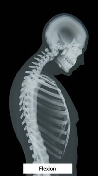 Neck flexion is the forward bending movement of the head and cervical spine, bringing the chin closer to the chest