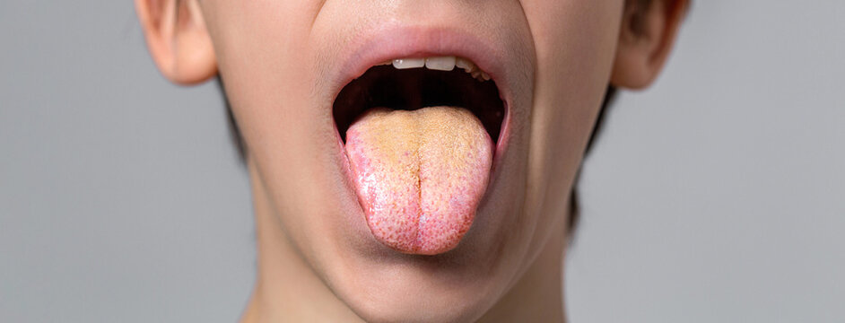 Tongue. Oral thrush. Boy showing her tongue. Child puts out tongue - closeup. Close-up of a little boy tongue with bacterial patina