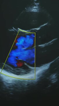 Dynamic image of beating heart appears on monitor during procedure. Image of heart visible on screen during diagnostic process. Vertical video