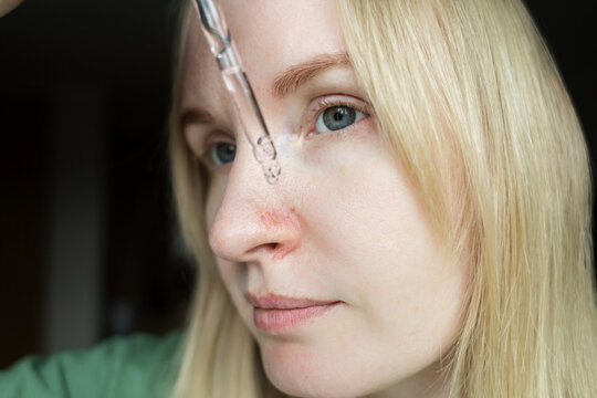 Close-up of woman applying serum with pipette on face with couperose and rosacea symptoms on nose. Professional skincare treatment for dilated capillaries and redness.