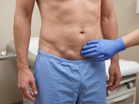 Inguinal Hernia Real Pictures &ndash; Helpful Visual Image Reference