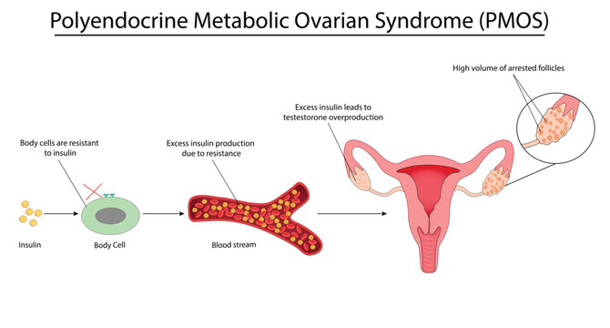 Polyendocrine Metabolic Ovarian Syndrome (PMOS) vector illustration
