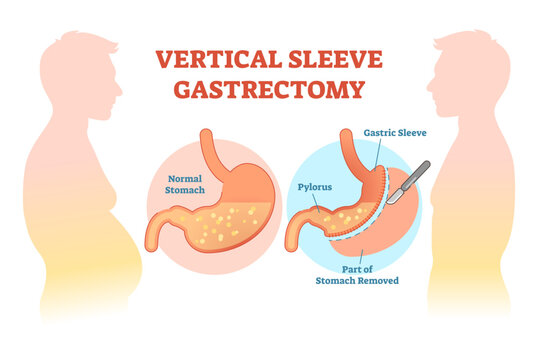 Vertical Sleeve Gastrectomy medical illustration diagram with stomach surgical cut, transparent background.Anatomical diagram.