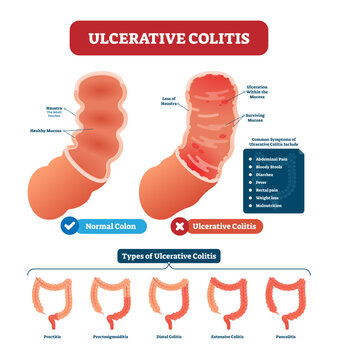 Ulcerative colitis illustration, transparent background. Labeled anatomical infographic with structure, symptoms and types. Haustra and mucosa location. Healthy and disordered comparison.