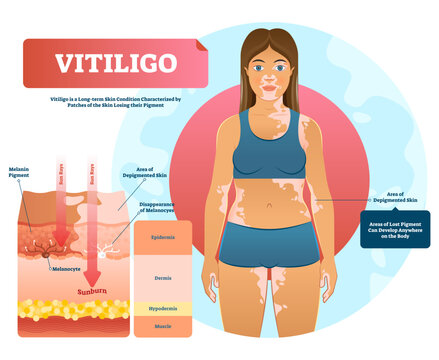 Vitiligo illustration, transparent background. White pigment disease with pigment loss. Skin depigmentation and genetic illness. Diagram with epidermis, dermis, hypodermis and muscle.