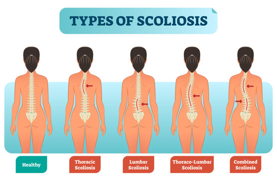 Types of scoliosis medical anatomical illustration diagram with spine curvatures compared with healthy back bone, transparent background. Back view female with labels.