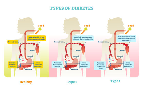Types of diabetes illustration diagram scheme, transparent background. Medical educational information.