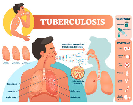 Tuberculosis illustration, transparent background. Detailed diagnosis symptoms and treatment scheme. Diagram with latent infection, cavitary or miliary illness. Educational lung structure