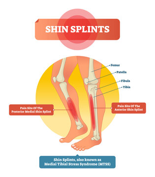 Shin splints illustration, transparent background. Leg muscle sport trauma and bone pain labeled diagram. Isolated femur, patella, fibula, tibia and foot bones with shown injury location.