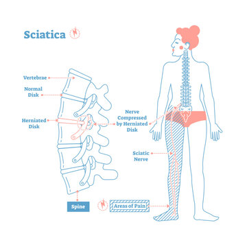 Sciatica medical health care illustration scheme with lower spine and sciatic nerve pain in leg, transparent background. Backbone diagram with vertebrae, disks and nerves.