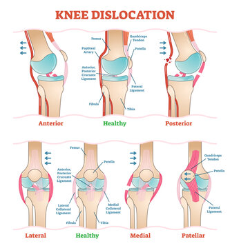 Knee dislocations - medical illustration diagrams, transparent background. Anatomical knee injury types scheme. Physiotherapy educational information.