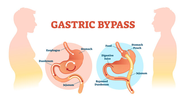 Gastric bypass medical surgery procedure illustration with esophagus, stomach, duodenum and jejunum flow, transparent background. Anatomical diagram with normal stomach and bypassed.