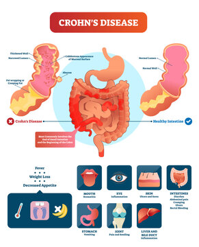 Crohns disease illustration, transparent background. Labeled diagram with diagnosis and symptoms. Infographic with disorder and healthy intestine. Structure with gastrointestinal tract.