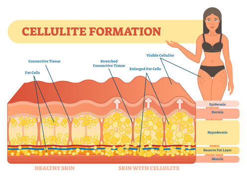 Cellulite formation illustration diagram, medical information scheme, transparent background. Womans beauty and skicare.