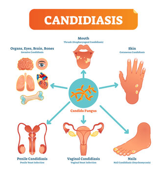 Candidiasis medical illustration diagram poster with all types of candida fungus on various human body parts and organs, transparent background.Health care bacterial information.