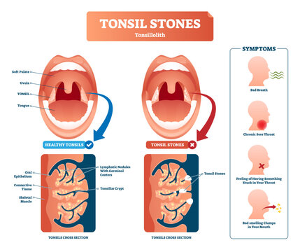 Tonsil stones illustration, transparent background. Labeled medical tonsillolith symptoms scheme. Healthy respiratory anatomy structore and cross section. Bacterial diagnosis with bad breath.