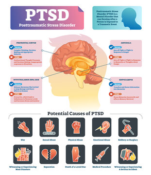PTSD illustration, transparent background. Labeled anatomical mental disorder causes scheme. Compared healthy and problematic brain differences set. Explained psychiatry diagnosis after disasters.