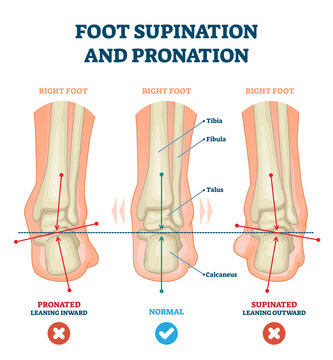 Foot supination and pronation illustration, transparent background. Labeled medical scheme with incorrect leg joint movement. Educational diagram with pronated, normal and supinated compared examples.