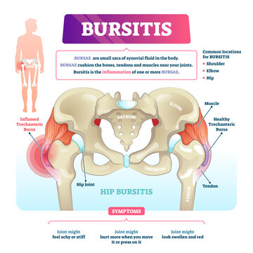 Bursitis illustration, transparent background. Labeled bursae synovial inflammation scheme. Bone and tendon illness and disease diagnosis. Educational chronic problem symptoms.