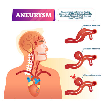 Aneurysm illustration, transparent background.Labeled medical outward bulging vessel scheme.Educational anatomical graphic with inner organs problem explanation.