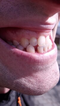 A side profile view captures a man mouth and jawline showing teeth in natural sunlight. Concept of dentistry, oral hygiene, dental health, malocclusion, and orthodontic care.
