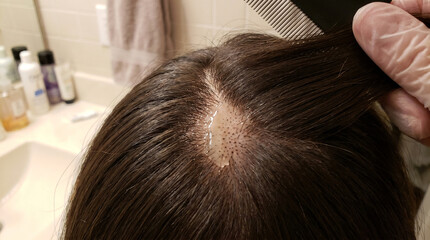 Fototapeta premium Applying clear serum treatment to scalp bald spot