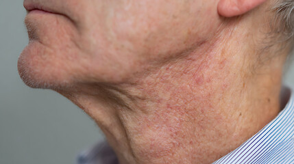 Naklejka premium Close-up of an older person's neck and jawline, showing aged skin texture and signs of sun damage or irritation in a medical context
