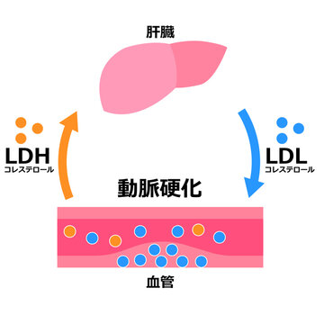 LDLとLDH